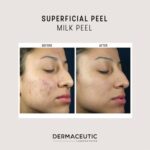 Chemical Peels 