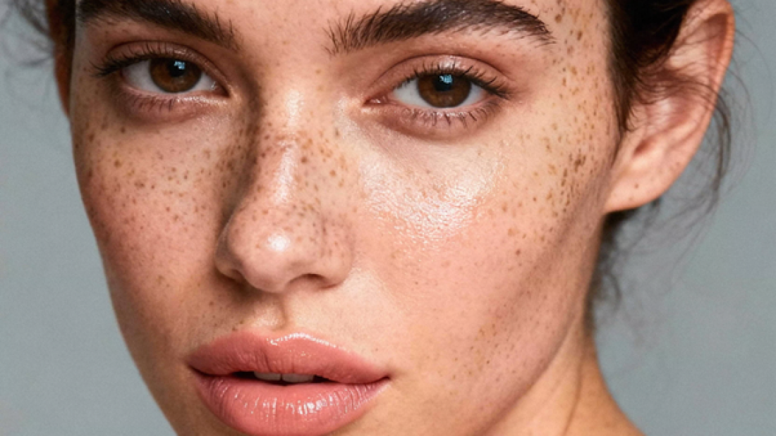 Woman with freckles and dark spots