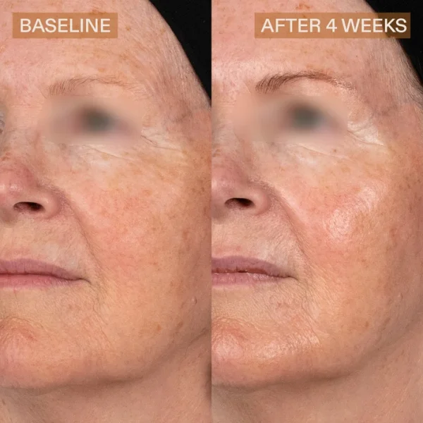The Skin Diary Pro Helix C before and after image